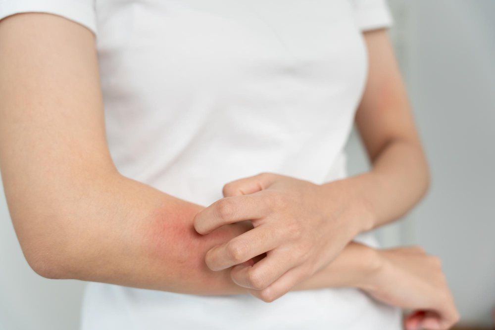 Skin problem and beauty Young woman scratch body has itchy skin from skin allergic ste